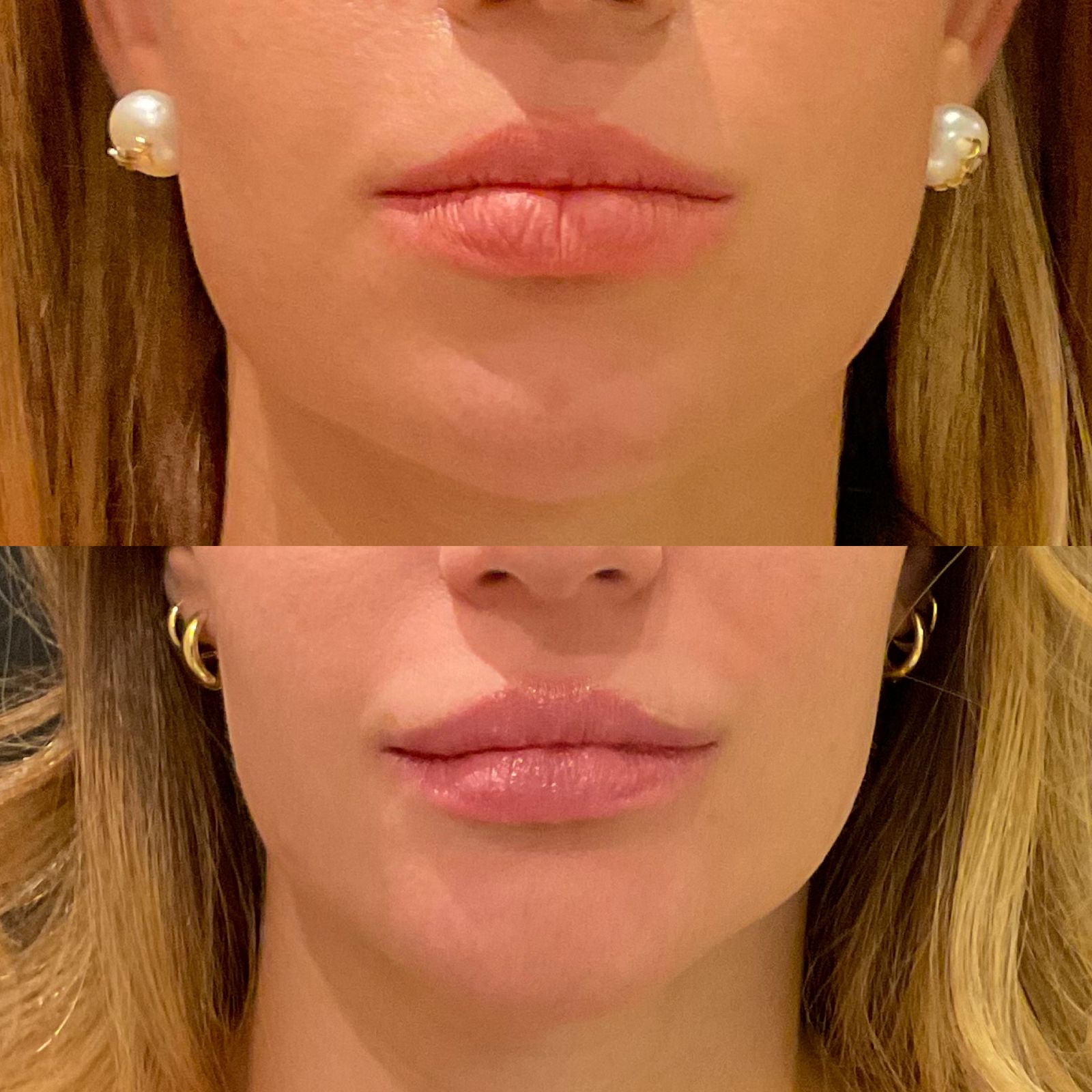 preenchimento-labial-goiania